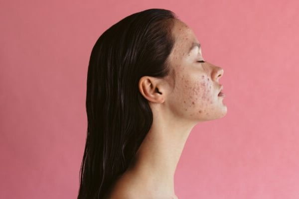 10 Cara Mengurangi Jerawat Hormonal Secara Alami