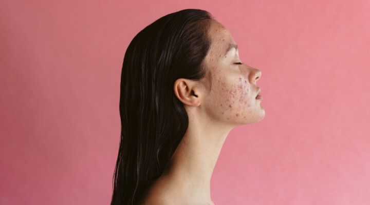 10 Cara Mengurangi Jerawat Hormonal Secara Alami