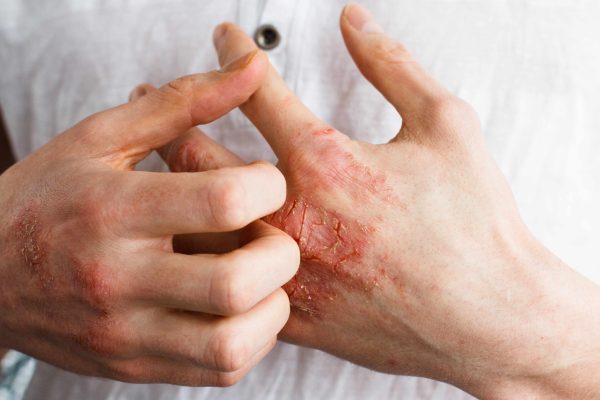 10 Cara Alami Meredakan Gatal Akibat Alergi 10 Cara Alami Meredakan Gatal Akibat Alergi