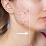 10 Cara Menyembuhkan Jerawat Tanpa Meninggalkan Luka