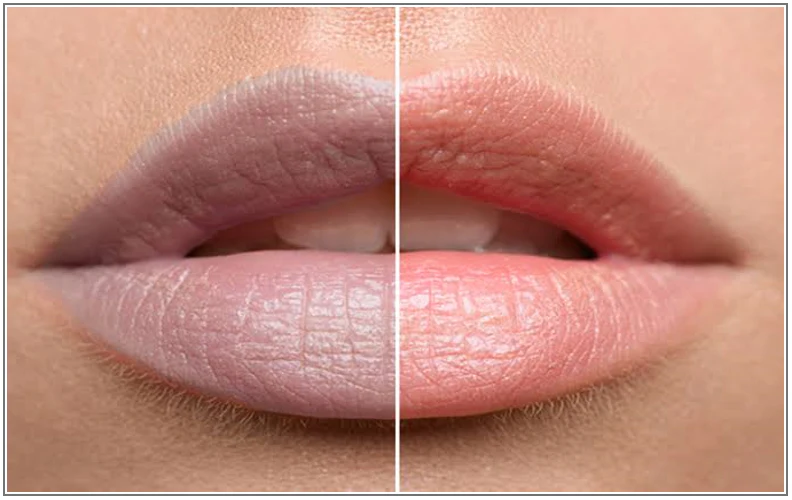 7 Cara Menghilangkan Warna Gelap di Bibir secara Alami